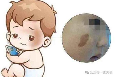 胎记算命方法介绍