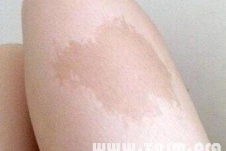 人体胎记算命的解释分析