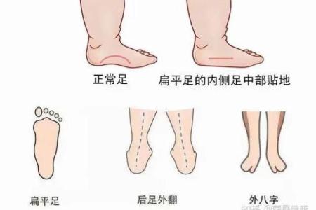 足脊健康知识小课堂（第三期） -  外八字篇