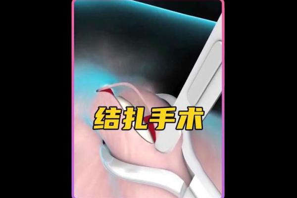 八字结扎