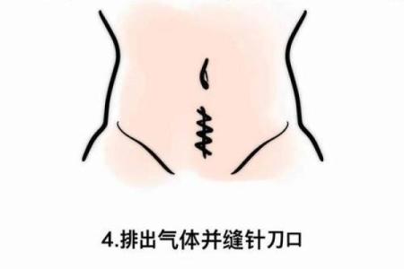 八字结扎