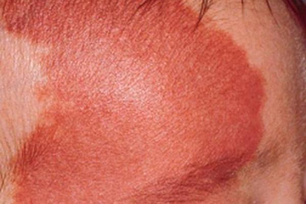 看胎记颜色类型算命 看胎记颜色类型算命