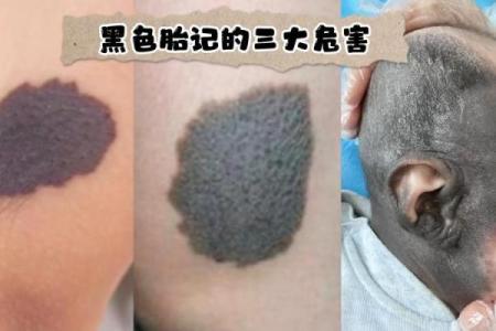 看胎记颜色类型算命